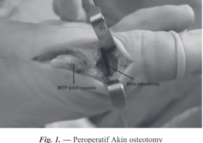 Fig. 1. — Peroperatif Akin osteotomy