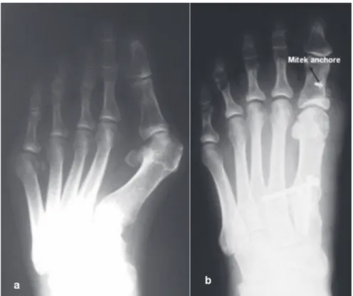 Fig. 4. — 45 year old female left foot; a) preoperative and b) postoperative (Akin procedure) radiography