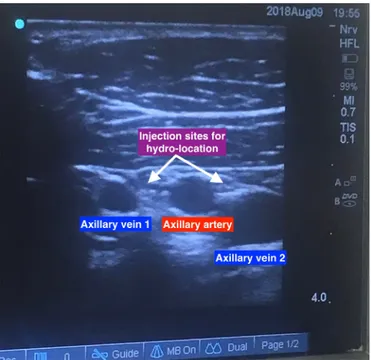 figure 1  Double axillary veins and single axillary artery diagnosed  with ultrasonography.
