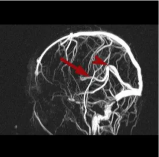 Figure 3: Internal cerebral veins (arrow) and GV (arrowhead) in MIB images 
