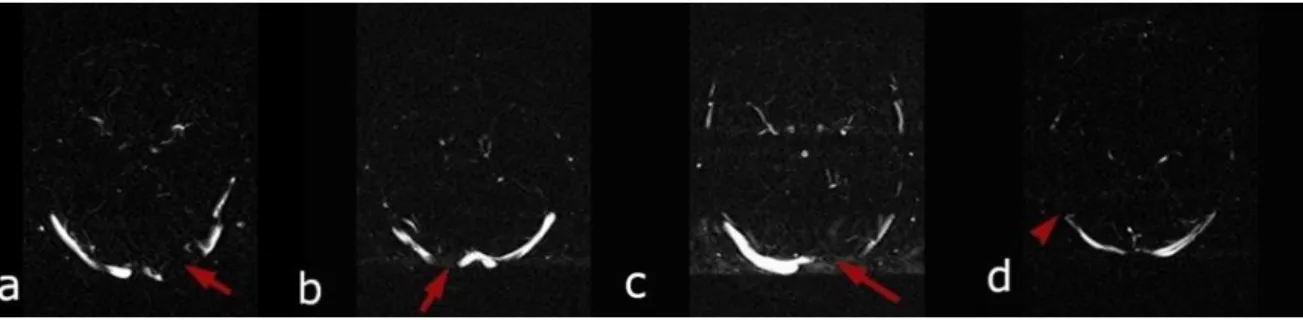 Figure 6: Physiological filling defects of TS a. Filling defect of left inner and middle  segments (arrow) b