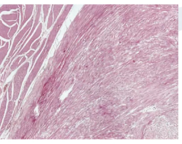 Figure 1: Tumor composed of bundles of  spindle shaped cells located in the muscular 