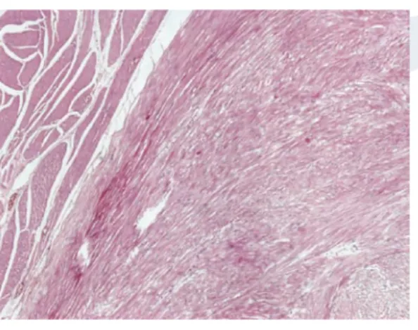 Figure 1: Tumor composed of bundles of  spindle shaped cells located in the muscular 
