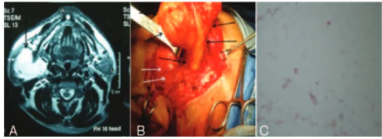 FIGURE 1. A, MRI image of the mass (arrow) is seen (in T1 sequence, lipoma is seen hiperintense)