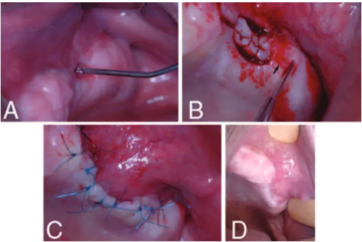 FIGURE 1. (A) Preoperative irrigation with 0.9% saline solution. (B) Filled fistula, trapezoidal incision, and scarification of 5 mm of flap (arrow)
