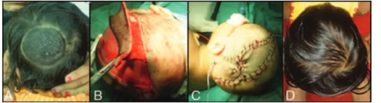 FIGURE 1. A, Coronal CT showed loss of aeration at both maxillary sinuses. B, T1-weighted MRI showed elongation of polyps to choana