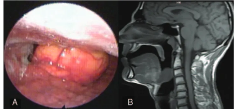 FIGURE 1. A, Flexible laryngoscopic view of huge vallecular cyst. B, Sagittal T1 magnetic resonance image showing a vallecular cystic mass subtotal narrowing the airway.