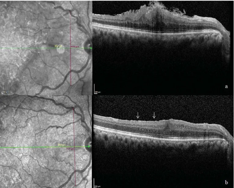 Figure 2a. Preoperative infrared and B-scan optical coherence tomography image of a patient.