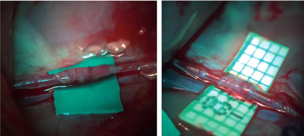 Figure 3. Thirty minutes after finishing anastomoses by using amniotic membrane vessel patency was seen.