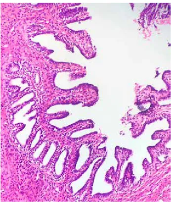 Figure 3. Histopathological apperance of Müllerian  duct remnants. Micropapillary wall projections and  microtubular spaces which were covered by one layer 