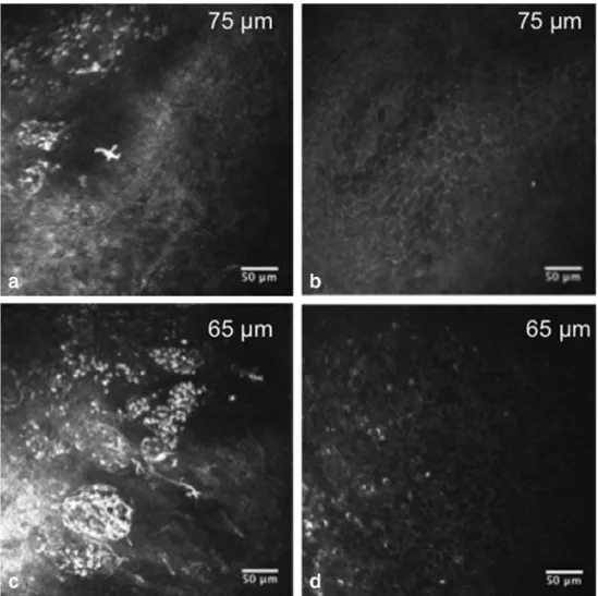 Fig. 1 a, c Widespread inflammation including dendritic cells, polymorphonuclear cells, and/or lymphocytes can be observed in the conjunctival epithelium in a 52-year-old woman with SS
