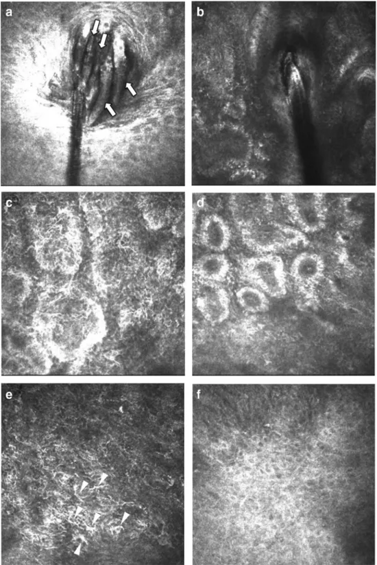 Fig. 3 a Heavy demodicosis infestation of eyelash follicles in a 72-year-old female patient shown by in vivo confocal microscopy
