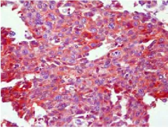 Fig 1: Nuclear p53 positive staining (p53 x 100) Fig 2: Cytoplasmic KAI1 positive staining (KAI1 x 200)