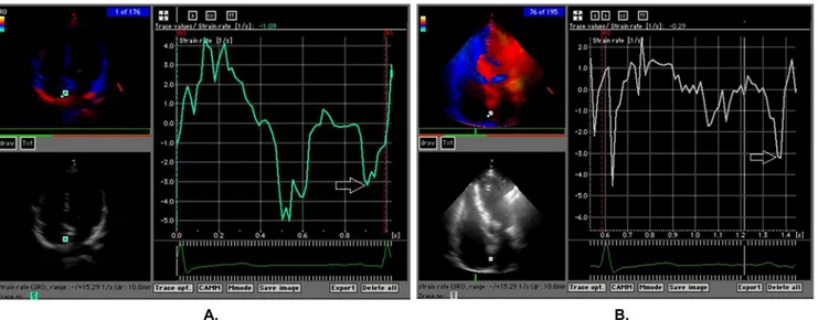 Figure 3. Interatrial septal strain rate measurements from the interatrial septum in a control subject (A) and a subject with PHT (B)