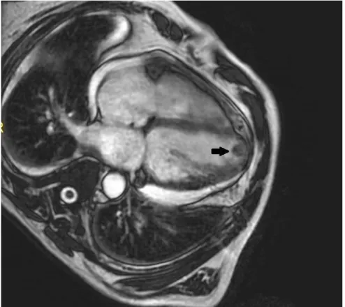 Figure 2: The left ventricle are shown in long axis planes in cardiac magnetic resonance