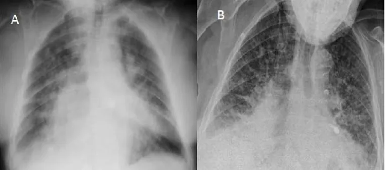 Figure 1: A: Chest radiography shows cardiomegaly and alveolar edema in the upper lobes