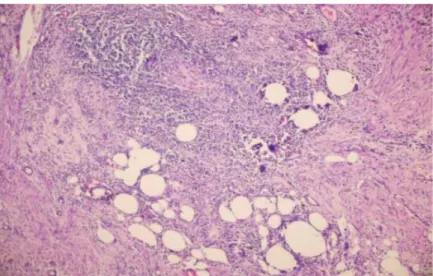 Figure 3) Histopathology findings included inflammation in the gallbladder wall  cholesterol clefts Body type and Touton type giant cells
