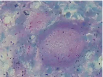 Figure 1. Lymph node, granuloma formation with mononuclear  luekocyte  infiltration,  necrosis,  calsification  and  surrounding  connective tissue(HEx4, case 16)