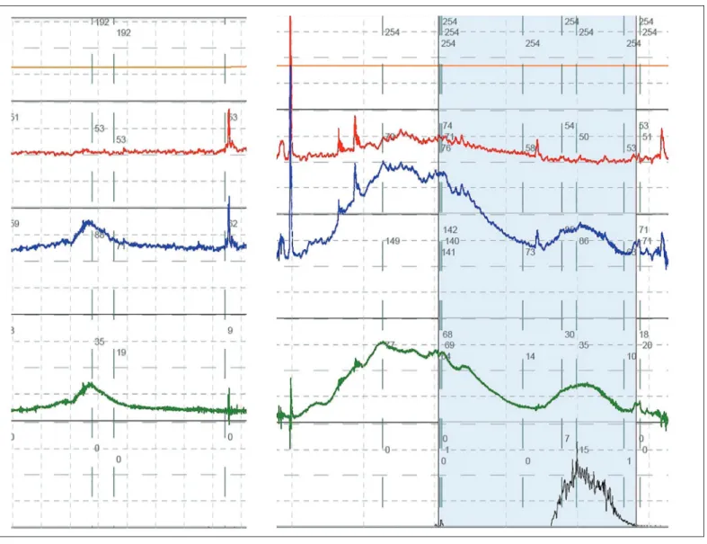 Figure 2. Detrusor overactivity during filling cystometry. On the left, a bladder contraction (increase in pressure in P det , caused by 