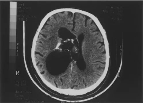Figure 1: Non enhanced axial CT section at the level of the lateral ventricle shows a