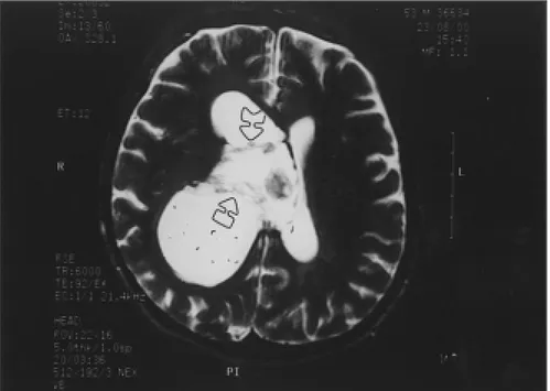 Figure 3: On the T2-weighted image, the cystic parts appear isointense with