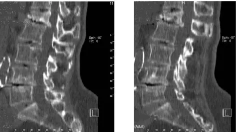 Figure 1. Computerized tomography image of lumbar vertebras. 