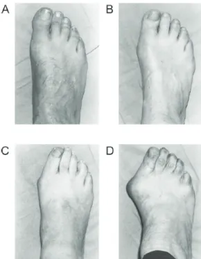 Şekil 1: Manchester Skalası: A: deformite yok, B: Hafif şiddette HV,  C: orta şiddette HV, D: çok şiddetli HV 