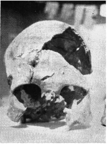 Fig. 3: The Skull of Alaca Höyük Al. H. MII in norma frontalis. 