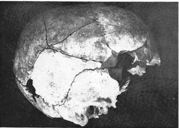 Fig. fi: The Skull of Alaca Höyük Al. F. No. I in norma laterali:  ( Not on the Frankfort plane ) 