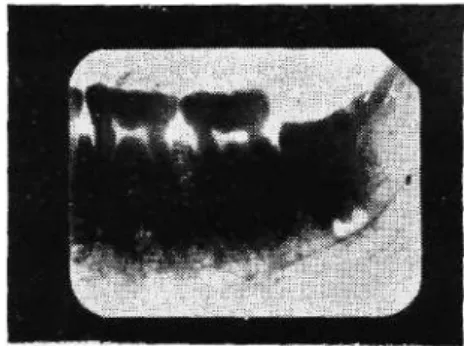 Fig. 11: The skiagram of the lower teeth  of Alaca Höyük Al. H. MII (left side ). 