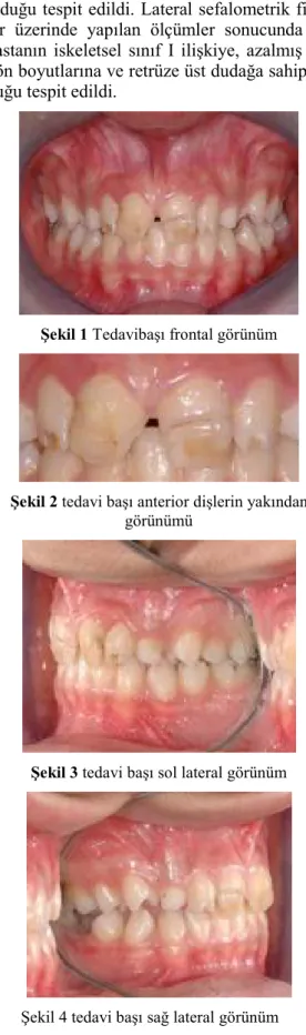 Şekil 1 Tedavibaşı frontal görünüm 