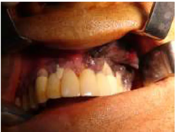 Şekil 1:  Preoperatif intraoral görüntüsünde izlenen 