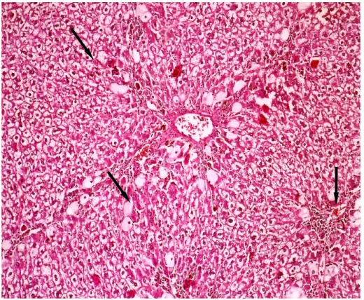 Figure 1. Numerous ballooned hepatocytes are seen in the liver of the CCl 4  group (Hematoxylin-eosin stain, 