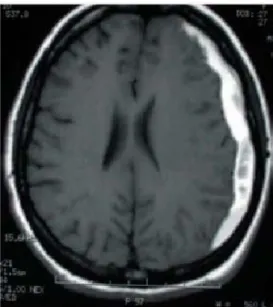 Şekil 1. Hiperyoğun subdural beyin kanamalı MRG örneği 