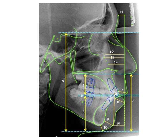 Şekil 1. Yumuşak doku kalınlık ölçümleri: (1) Üst dudak uzunluğu (Sn’-ULI); (2) Interlabial mesafe (ULI-LLS); (3) Alt dudak uzunluğu (LLS-