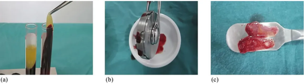 Figure 1- Concentrated growth factor (CGF). (a) Clots form and centrifuge tubes. (b) A special compressor