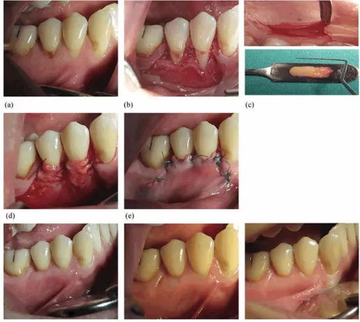 Figure 3- Control group. (a) Preoperative view. (b) Flap design and vertical incisions