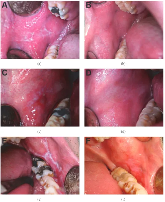 Figure 2: Intraoral views of selected patients before and after treatment. (a), (c), (e) Prior to the replacement with feldspathic inlay- inlay-onlay restorations, lichenoid lesions were characterized by white striations