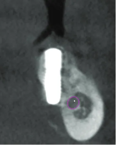 Figure 2. Three types of mandibular cross-sectional ridge morphology  (CST) were determined.