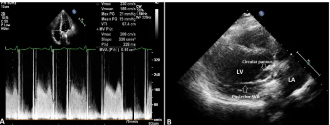 Figure 1. A. Transthoracic echocardiography (TTE) revealed mitral prosthetic valve obstruction with increased mean transpros- transpros-thetic gradient and decreased valve area