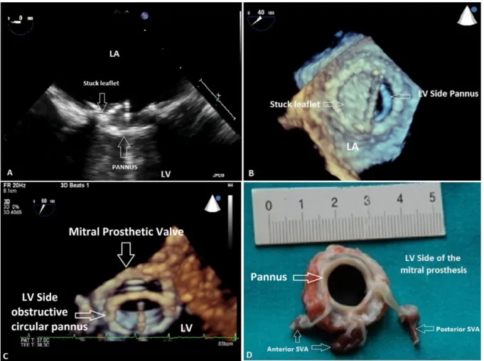 Figure 2. A. Two-dimensional transesophageal echocardiography (TEE) revealed a hyperechogenic circular mass on the left ven- ven-tricular side of the prosthesis causing one leaﬂet stuck in closed position