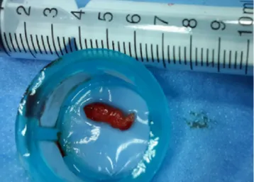 Figure 1. The thrombus aspiration with coronary thrombus aspiration cath- cath-eter yielded a worm-like thrombus material which ws histopathologically confirmed as thrombus.