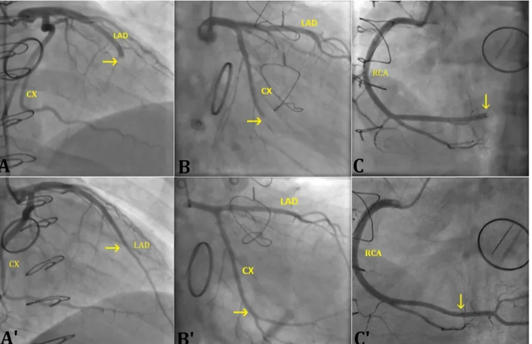 Figure 2. Coronary angiography demonstrated coronary thrombus in the left anterior descending (A), circumflex (B), and right coronary arteries (C) causing cut off pattern of coronary blood flow in a patient with the diagnosis of coronary embolism (A) and c