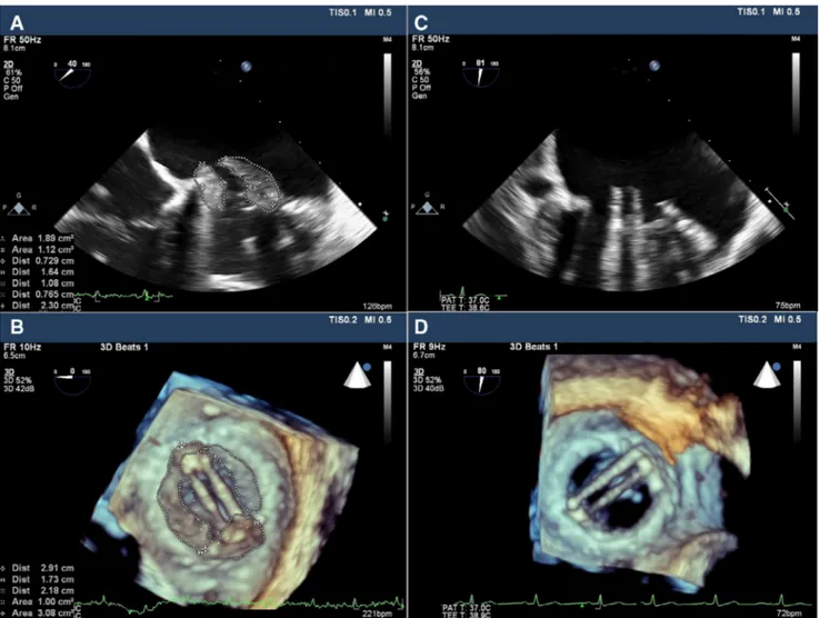 Figure 3. Two-dimensional and real-time three-dimensional transesophageal echocardiography demonstrated an obstructive thrombus on mitral prosthetic valve in a patient who admitted with non-ST elevation acute coronary syndrome (A and B) and complete lysis 