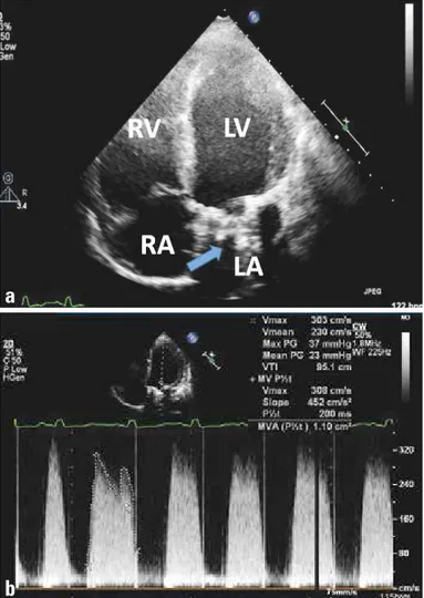 Figure 1. Two-dimensional transthoracic echocardiographic imaging  of mitral prosthetic valve thrombosis (arrow) in four-chamber view (a)  and increased transvalvular gradients and reduced mitral valve area, as  demonstrated by Doppler imaging (b).