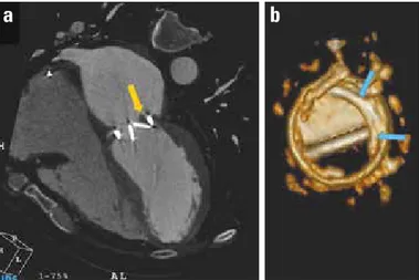 Figure 3. Multidetector computed tomography revealed a periprosthetic  mass with HU: 65 (favors thrombus), which restricted the mobility of one  of the leaflets (a)