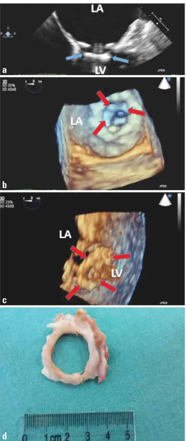 Figure 4. Two-dimensional transesophageal echocardiography (TEE)  revealed a hyperechogenic circular mass on the left ventricular side  of the prosthesis (a)