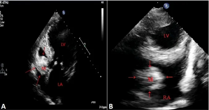 Figure 1. A. Transthoracic echocardiography apical four-chamber view demonstrated large mass on the tricuspid valve and B