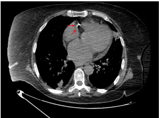 Figure 2. The MDCT views: a tumor-like mass with a hypo- hypo-dense central area and peripheral hypo-dense calci ﬁcation in the  tri-cuspid valve annulus (arrows).