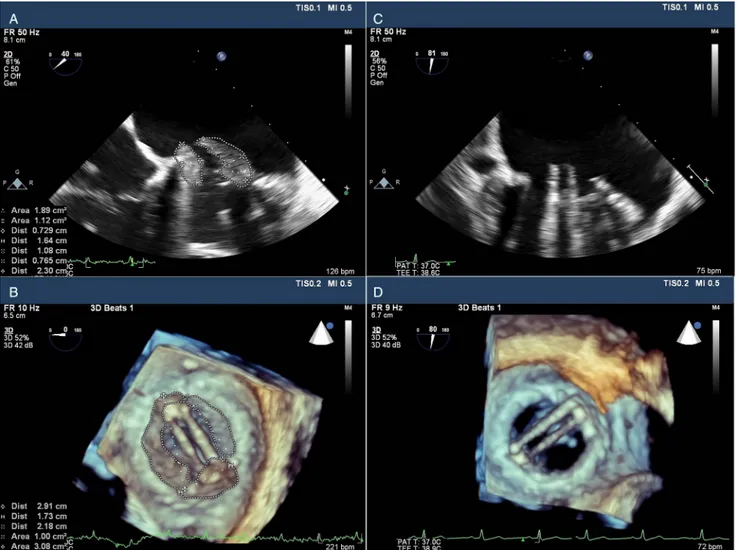 Fig. 1. Two-dimensional (A) and real-time three-dimensional (B) transesophageal echocardiography showed an obstructive thrombus on the mitral prosthesis on admission and complete lysis of the thrombus after thrombolytic therapy (C and D)